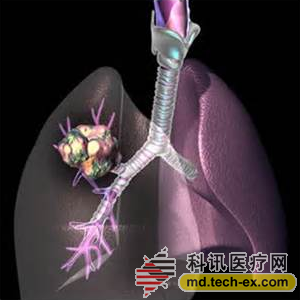 一种针对老年肺癌患者的安全有效的诊断工具