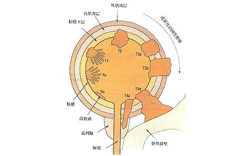 分析外泌体的吸收可能简化膀胱癌的诊断