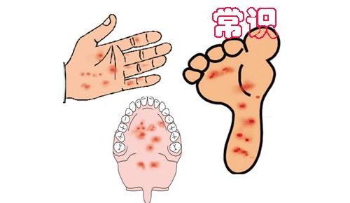 专家表示：手足口病病毒今年或有变异