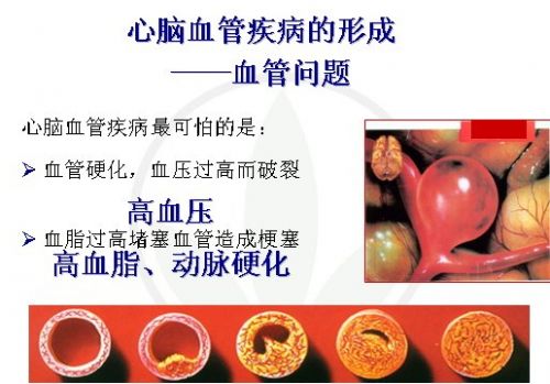 未来10年，你的心脑血管病风险是多少？