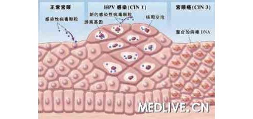 重视HPV16/18分型检测，完善宫颈癌筛查策略