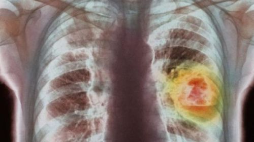 呼气就能测肺癌？英国将对新仪器进行临床试验