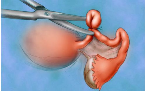 PNAS：mRNA诊断早期卵巢癌成为可能