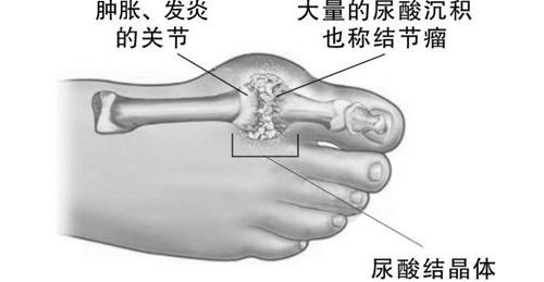 忽必烈的烦恼--漫谈痛风