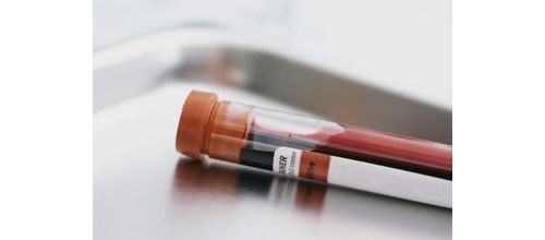 Sci Trans Med：血液检测可预测乳腺癌药物抵抗