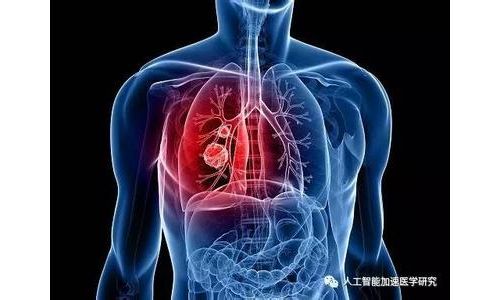 业内认可！深度卷积网络算法成熟，肺结节检测技术进入人工智能时代