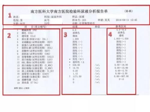 终于有了一种可准确检测结核病的尿液化验方法