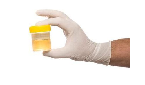 Sci Adv：科学家仅利用1毫升尿液就能诊断出多种类型癌症
