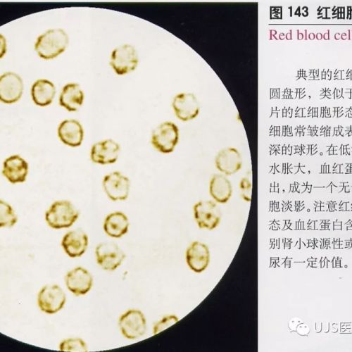 尿液有形成分形态学小结（第1部分）