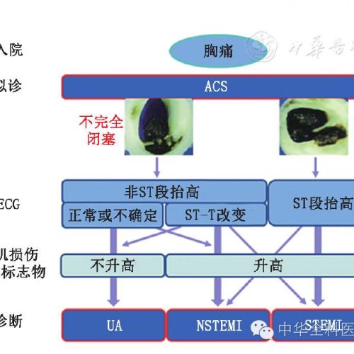 基层医院急性冠状动脉综合征临床诊疗中心肌肌钙蛋白检测应用专家共识