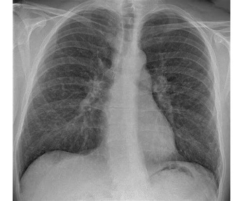 Cancer Res：新研究表明KRAS突变肺腺癌需要IKKα参与
