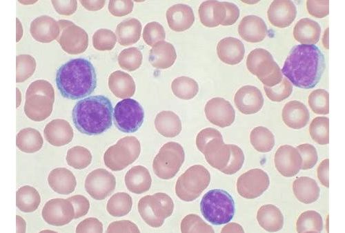 Cancer Dis：JAK/STAT信号促进白血病发生需要一重要分子协助