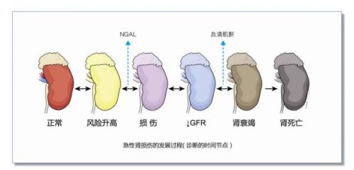 NGAL——肾损伤新标志物
