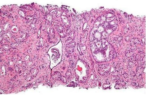 Clin Cancer Res：新型的遗传标记或有望实现早期诊断恶性的前列腺癌