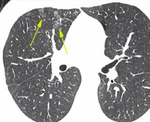 什么是特发性肺纤维病 000735lpv8p2kklutwk9ll.jpg