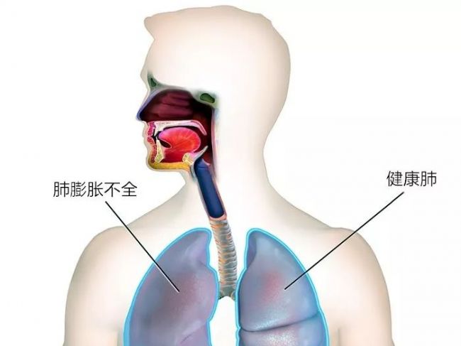 肿瘤基因检测丨有一种活检，叫液体活检；有一种标本，叫胸水上清！
