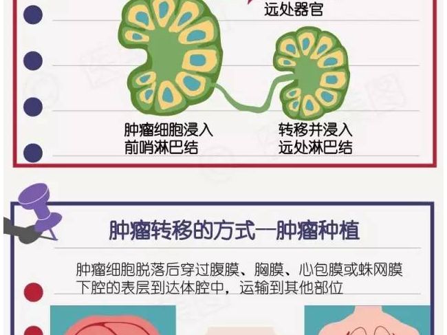 会“行走”的肿瘤：活体组织检查会不会引起癌症扩散？