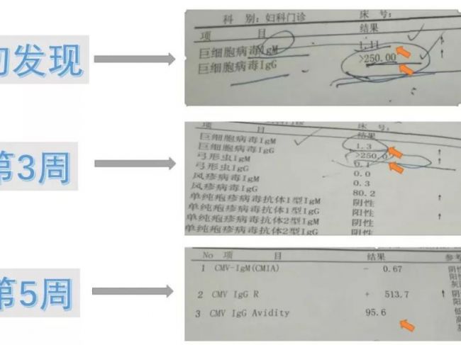 孕期TORCH检查呈抗体阳性，如何决定胎儿去留？
