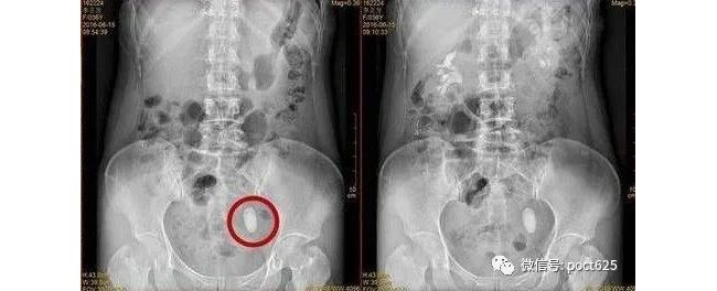 免疫分析中干扰物的排除